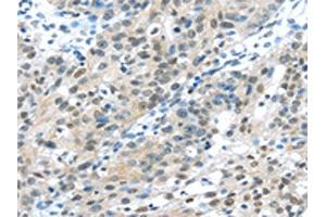 The image on the left is immunohistochemistry of paraffin-embedded Human breast cancer tissue using ABIN7131359(TKT Antibody) at dilution 1/30, on the right is treated with fusion protein. (TKT 抗体)