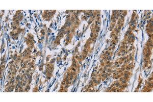 Immunohistochemistry of paraffin-embedded Human gasrtic cancer tissue using ACVR1 Polyclonal Antibody at dilution 1:60 (ACVR1 抗体)