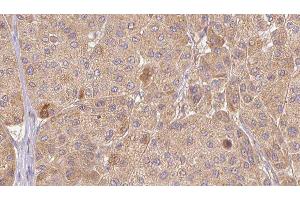ABIN6277349 at 1/100 staining Human Melanoma tissue by IHC-P. (CTGF 抗体  (Internal Region))