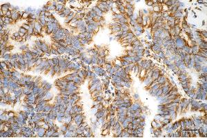 Immunohistochemistry was performed on paraffin-embedded human endometrial carcinoma using vimentin antibody (ABIN7800840), 1:100). (Recombinant Vimentin 抗体)