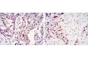 Immunohistochemical analysis of paraffin-embedded mammary cancer tissues (left) and lung cancer tissues (right) using STAT3 antibody with DAB staining. (STAT3 抗体)