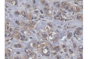 IHC-P analysis of Human Breast cancer Tissue, with DAB staining. (EEF2 抗体  (AA 32-233))