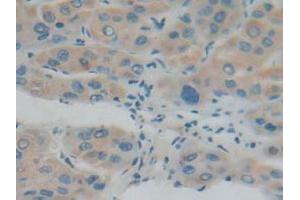 IHC-P analysis of Human Liver Cancer Tissue, with DAB staining. (IFNAR1 抗体  (AA 28-227))