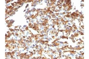 Formalin-fixed, paraffin-embedded human melanoma stained with anti-Vimentin antibody (VM1170). (Vimentin 抗体)