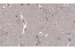 ABIN6276617 at 1/100 staining Human brain cancer tissue by IHC-P.