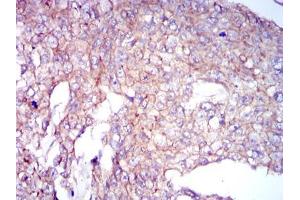 Immunohistochemical analysis of paraffin-embedded breast cancer tissues using COTL1 mouse mAb with DAB staining. (COTL1 抗体)