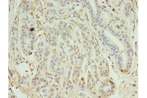 Immunohistochemistry of paraffin-embedded human breast cancer using ABIN7157263 at dilution of 1:100 (KEAP1 抗体  (AA 1-624))