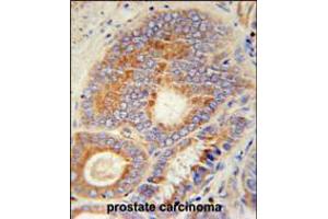 HHAT Antibody immunohistochemistry analysis in formalin fixed and paraffin embedded human prostate carcinoma followed by peroxidase conjugation of the secondary antibody and DAB staining. (HHAT 抗体  (N-Term))