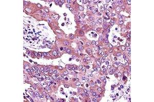 JAK2 antibody immunohistochemistry analysis in formalin fixed and paraffin embedded human lung adenocarcinoma. (JAK2 抗体  (AA 666-694))