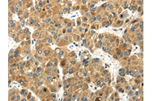 The image on the left is immunohistochemistry of paraffin-embedded Human liver cancer tissue using ABIN7193045(WFDC1 Antibody) at dilution 1/35, on the right is treated with synthetic peptide. (WFDC1 抗体)