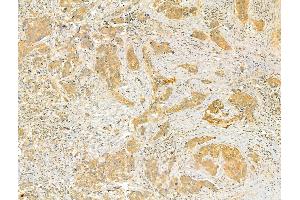 ABIN6265617 and ABIN6273082 at 1/100 staining Human breast cancer by IHC-P.