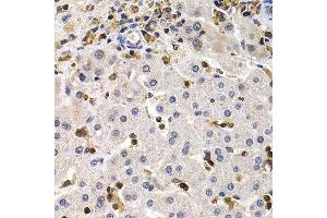 Immunohistochemistry of paraffin-embedded human liver cancer using BCL11A antibody at dilution of 1:200 (400x lens). (BCL11A 抗体)