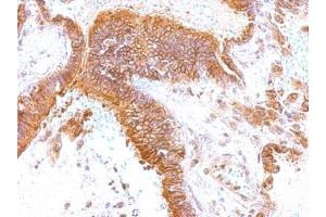 IHC-P Image GEM antibody [N1], N-term detects GEM protein at membrane on human lung by immunohistochemical analysis. (GEM 抗体  (N-Term))