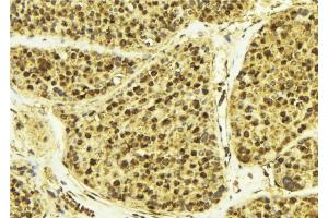 ABIN6268947 at 1/100 staining Human breast cancer tissue by IHC-P. (DREAM 抗体  (Internal Region))