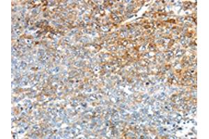 The image on the left is immunohistochemistry of paraffin-embedded Human ovarian cancer tissue using ABIN7192909(TRIM47 Antibody) at dilution 1/30, on the right is treated with synthetic peptide. (TRIM47 抗体)