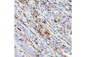 Immunohistochemistry of paraffin-embedded human colon carcinoma using Ferritin Heavy Chain Rabbit mAb (ABIN7267168) at dilution of 1:100 (40x lens). (FTH1 抗体)