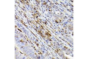 Immunohistochemistry of paraffin-embedded human colon carcinoma using Ferritin Heavy Chain Rabbit mAb (ABIN7267168) at dilution of 1:100 (40x lens). (FTH1 抗体)