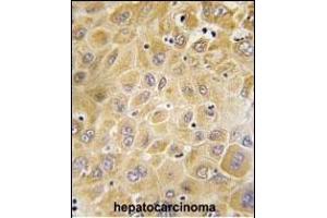 Formalin-fixed and paraffin-embedded human hepatocarcinoma tissue reacted with GRK7 Antibody (C-term) (ABIN392124 and ABIN2841868) , which was peroxidase-conjugated to the secondary antibody, followed by DAB staining. (GRK7 抗体  (C-Term))