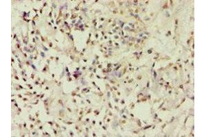 Immunohistochemistry of paraffin-embedded human breast cancer using ABIN7143182 at dilution of 1:100 (ACVR2B 抗体  (AA 19-140))