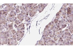 ABIN6273299 at 1/100 staining Human pancreas cancer tissue by IHC-P. (PMM2 抗体  (C-Term))