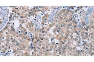 Immunohistochemistry of paraffin-embedded Human breast cancer using RAB8B Polyclonal Antibody at dilution of 1:40 (RAB8B 抗体)