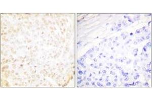 Immunohistochemistry analysis of paraffin-embedded human breast carcinoma tissue, using XRCC5 Antibody. (X-Ray Repair Cross Complementing 5 (AA 683-732) 抗体)