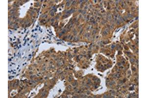 The image on the left is immunohistochemistry of paraffin-embedded Human ovarian cancer tissue using ABIN7192614(SPAG4 Antibody) at dilution 1/50, on the right is treated with synthetic peptide. (SPAG4 抗体)