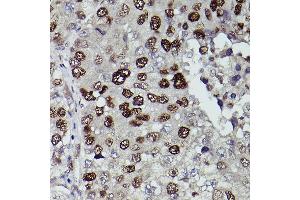 Immunohistochemistry of paraffin-embedded human liver cancer using KDM3A Rabbit pAb (ABIN6134725, ABIN6142790, ABIN6142791 and ABIN6215526) at dilution of 1:150 (40x lens). (KDM3A 抗体  (AA 350-450))