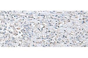 Immunohistochemistry of paraffin-embedded Human liver cancer tissue using EPM2A Polyclonal Antibody at dilution of 1:55(x200) (EPM2A 抗体)