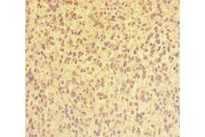 Immunohistochemistry of paraffin-embedded human glioma using ABIN7147689 at dilution of 1:100 (CHTOP 抗体  (AA 179-248))
