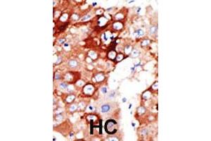 Formalin-fixed and paraffin-embedded human hepatocellular carcinoma tissue reacted with the ACSL4 polyclonal antibody  , which was peroxidase-conjugated to the secondary antibody, followed by DAB staining. (ACSL4 抗体  (AA 244-274))