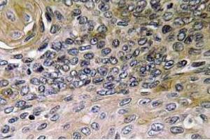 Immunohistochemistry (IHC) analyzes of IL-8 antibody in paraffin-embedded human lung carcinoma tissue. (IL-8 抗体)