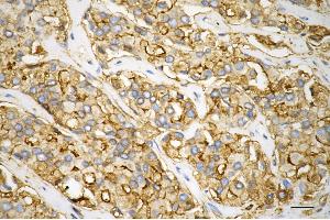 Immunohistochemistry was performed on paraffin-embedded human prostatic adenocarcinoma using annexin A5 antibody (ABIN7797621), 1:100). (Annexin V 抗体)