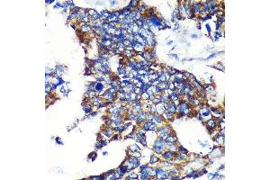 Immunohistochemistry of paraffin-embedded Human colon carcinoma using ESPN Rabbit pAb (ABIN7267008) at dilution of 1:100 (40x lens). (Espin 抗体  (AA 585-854))