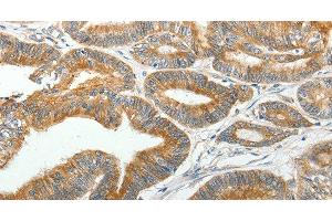 Immunohistochemistry of paraffin-embedded Human colon cancer tissue using SLC12A4 Polyclonal Antibody at dilution 1:30 (SLC12A4 抗体)