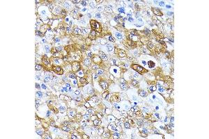 Immunohistochemistry of paraffin-embedded human esophageal cancer using  antibody  at dilution of 1:100 (40x lens). (ATG7 抗体)
