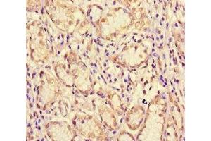 Immunohistochemistry of paraffin-embedded human gastric cancer using ABIN7160996 at dilution of 1:100 (ME1 抗体  (AA 161-519))