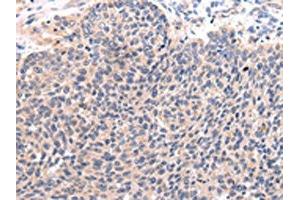 The image on the left is immunohistochemistry of paraffin-embedded Human lung cancer tissue using ABIN7190092(CCL7 Antibody) at dilution 1/20, on the right is treated with synthetic peptide. (CCL7 抗体)