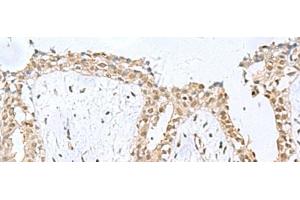 Immunohistochemistry of paraffin-embedded Human breast cancer tissue using KDM2B Polyclonal Antibody at dilution of 1:50(x200) (KDM2B 抗体)