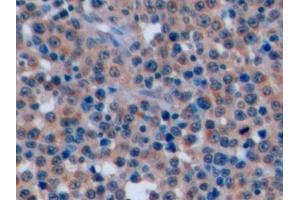 Detection of CD7 in Human Lymphoma Tissue using Polyclonal Antibody to Cluster Of Differentiation 7 (CD7) (CD7 抗体  (AA 26-134))