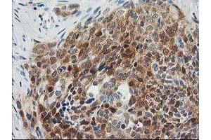 Immunohistochemical staining of paraffin-embedded Adenocarcinoma of Human breast tissue using anti-OSBP mouse monoclonal antibody. (OSBP 抗体)