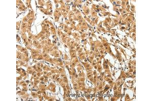 Immunohistochemistry of Human thyroid cancer using MAP1A Polyclonal Antibody at dilution of 1:40 (MAP1A 抗体)