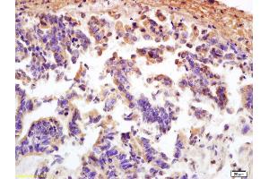 Formalin-fixed and paraffin embedded human rectal carcinoma labeled with Anti MCP1/CCL2 Polyclonal Antibody (ABIN675863), Unconjugated at 1:200, followed by conjugation to the secondary antibody and DAB staining (CCL2 抗体)