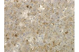 ABIN6259072 and ABIN6273576 at 1/100 staining human melanoma by IHC-P. (VSIG2 抗体  (Internal Region))