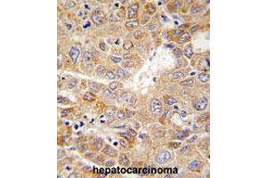 Formalin-fixed and paraffin-embedded human hepatocarcinomareacted with PGK1 polyclonal antibody , which was peroxidase-conjugated to the secondary antibody, followed by AEC staining.