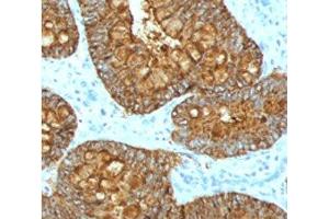 IHC testing of FFPE human colon carcinoma with MAML3 antibody (clone MMLP3-1). (MAML3 抗体)