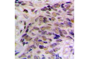 Immunohistochemical analysis of HES6 staining in human prostate cancer formalin fixed paraffin embedded tissue section. (HES6 抗体  (N-Term))