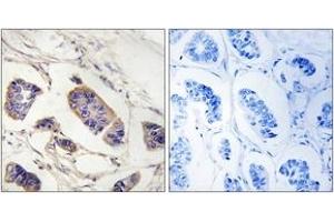 Immunohistochemistry analysis of paraffin-embedded human breast carcinoma tissue, using PEX7 Antibody. (PEX7 抗体  (AA 204-253))