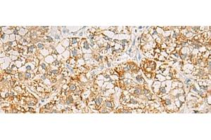 Immunohistochemistry of paraffin-embedded Human liver cancer tissue using SH3YL1 Polyclonal Antibody at dilution of 1:55(x200) (SH3YL1 抗体)