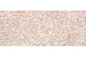 Immunohistochemistry of paraffin-embedded Human ovarian cancer tissue using FAN1 Polyclonal Antibody at dilution of 1:30(x200) (FAN1 抗体)